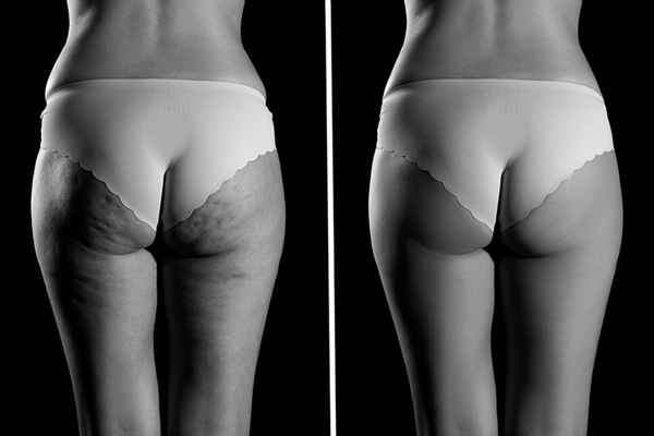 cellulite treatment