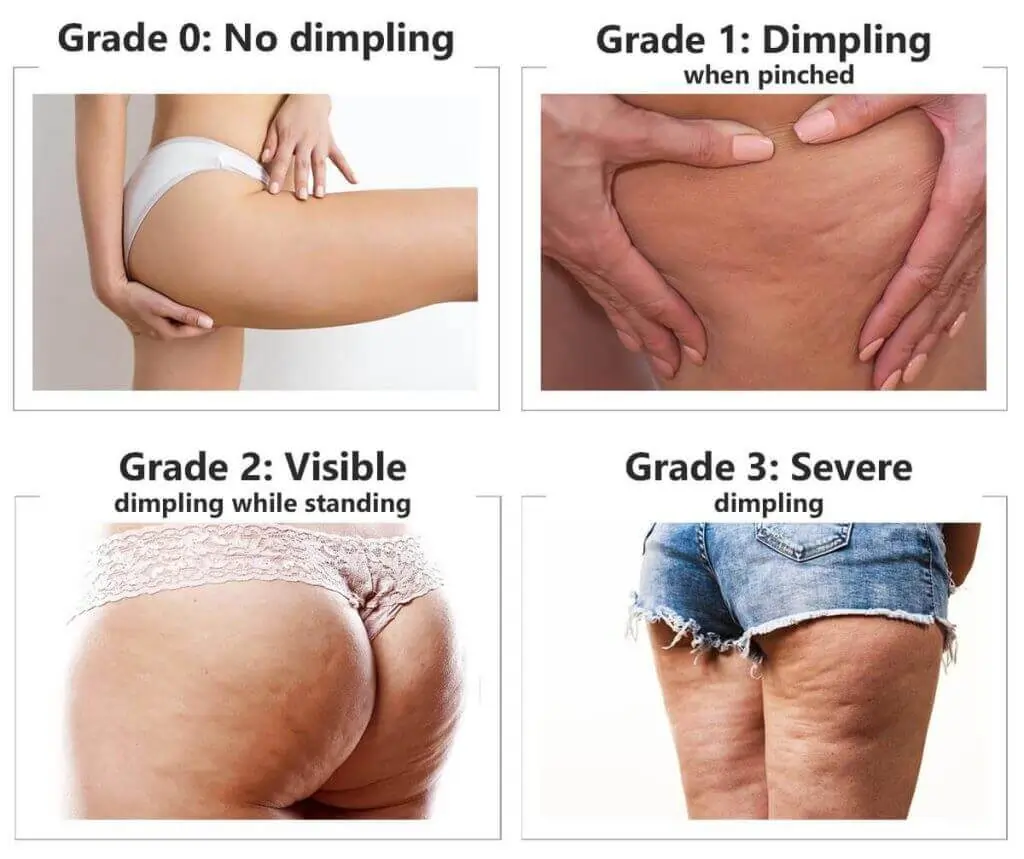 Representation of the stages of cellulite development Maplehurst